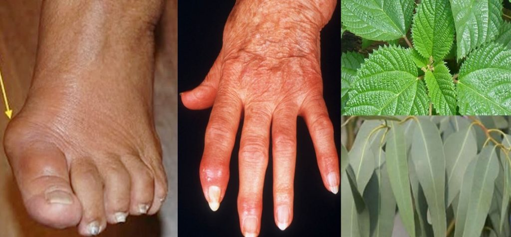 Remédios caseiros para artrite