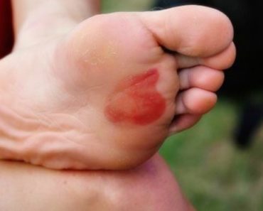remédios caseiros para curar bolhas nos pés