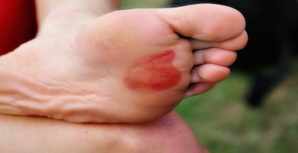 remédios caseiros para curar bolhas nos pés