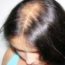 métodos caseiros para impedir a queda de cabelo