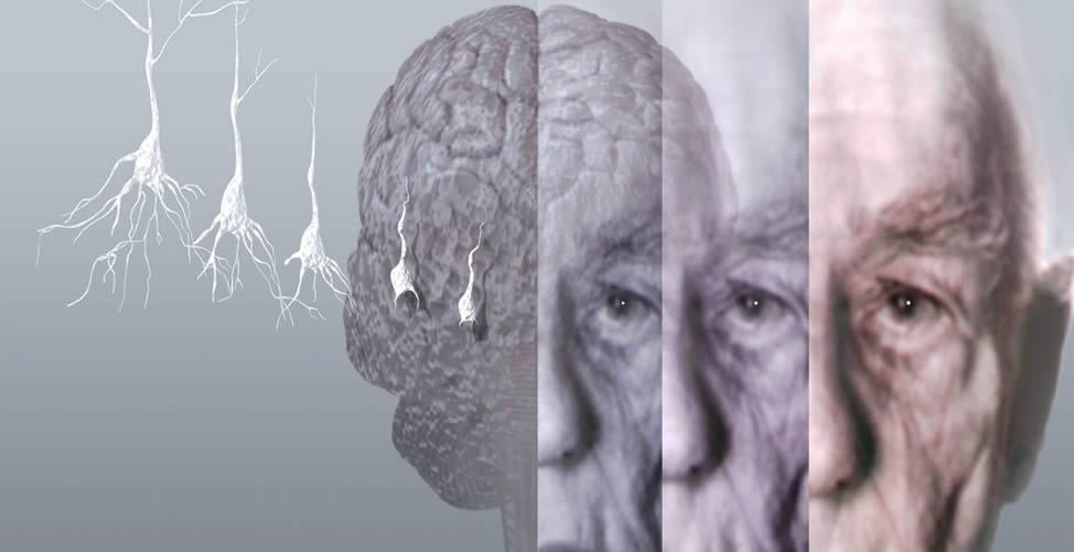Remédio Caseiro Para o Alzheimer -Sintomas